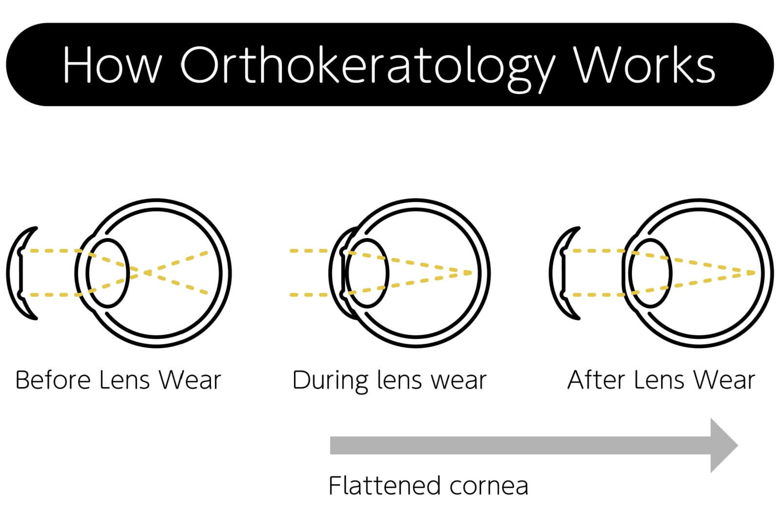 A diagram with eyeballs explains how orthokeratology works.