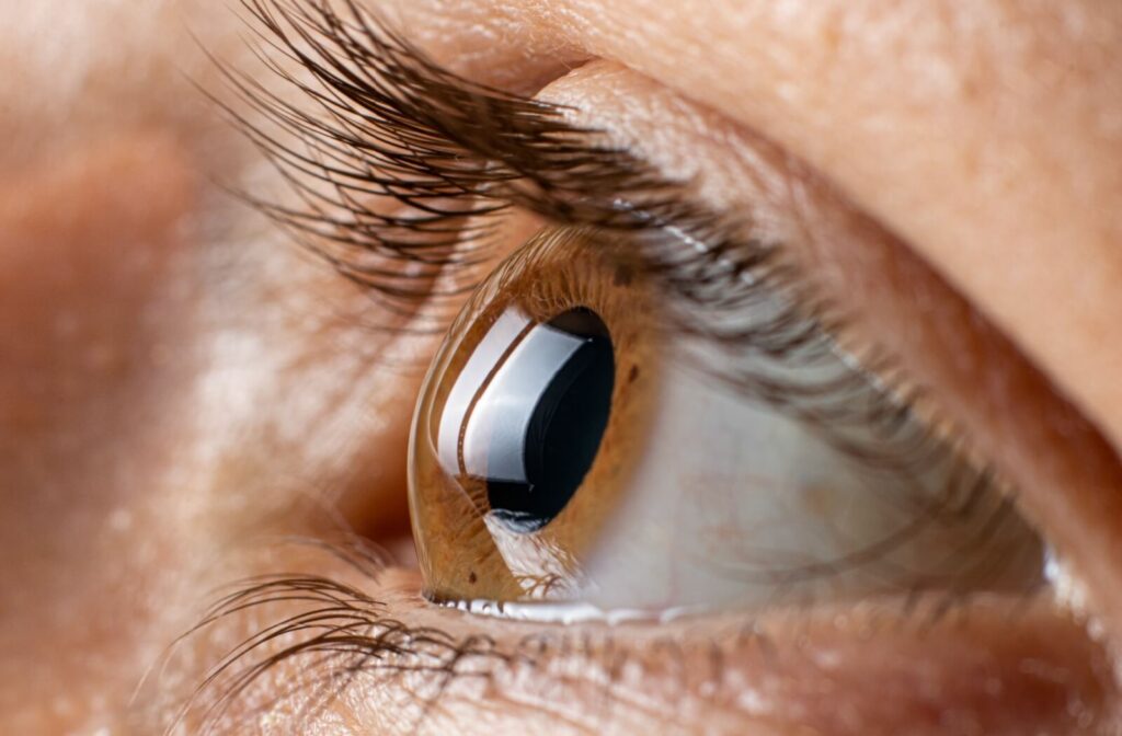 Close-up of an eye wearing a scleral contact lens highlighting the fit and comfort over the cornea