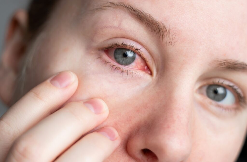 Someone with a red irritated right eye.